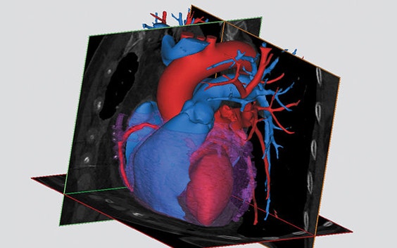 3D digital model of a heart in software