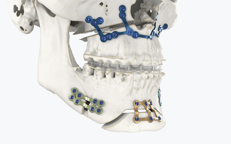 Untere Hälfte eines Schädels mit 3D-gedruckten Schienen und Implantaten
