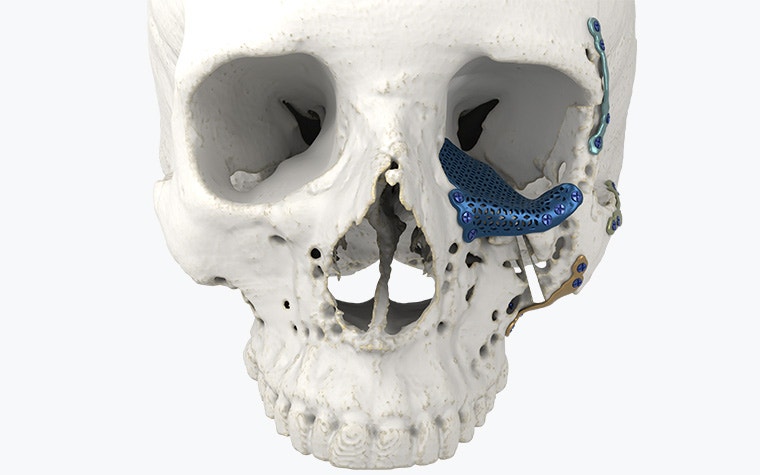 Vorderansicht eines Schädelmodells mit 3D-gedruckten Implantaten im Bereich des linken Auges