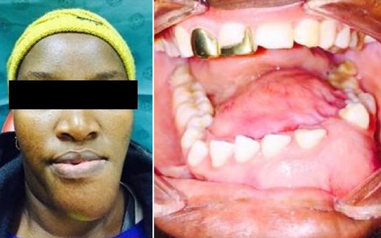Left: image of the anonymized patient. Right: Image of the inside of the patient's mouth