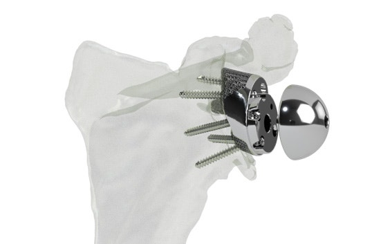 Image numérique montrant un implant imprimé en 3D dans un os de l'épaule.