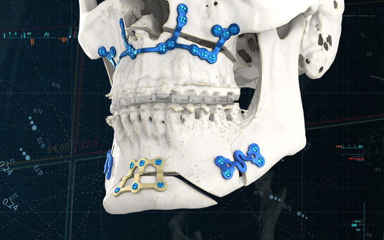 Angled view of a skull model with 3D-printed, personalized plates in place to connect displaced skull fragments