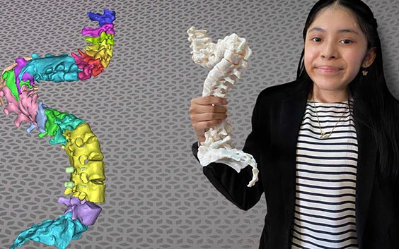 Patient holding a 3D-printed model of her spine next to a digital image of her spine