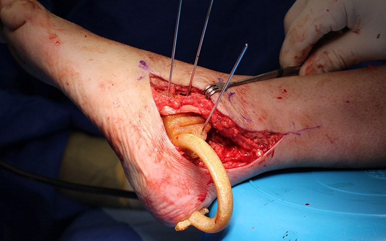 A personalized instrument in an ankle during surgery