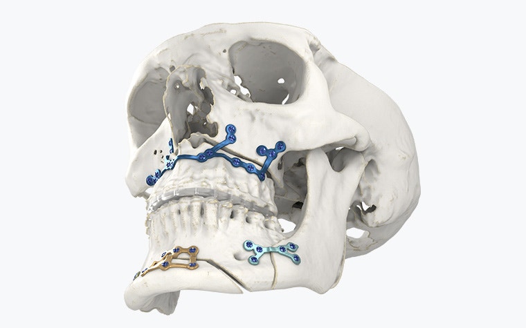 Vue angulaire d'un modèle de crâne avec des implants imprimés en 3D.