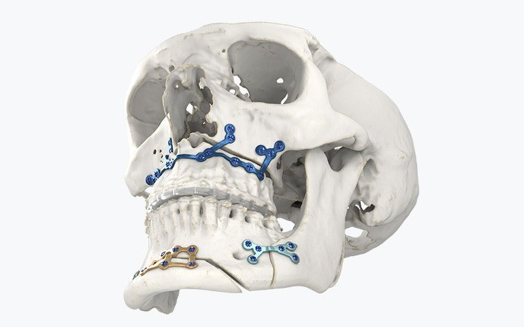 Angled view of a skull model with 3D-printed implants attached