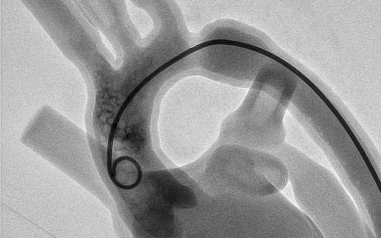 X-ray of the catheter in the water-filled and pulsating heart 