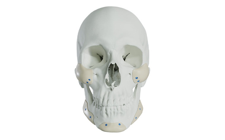 A front-facing skull with multiple midface and mandible PEEK implants fixated.