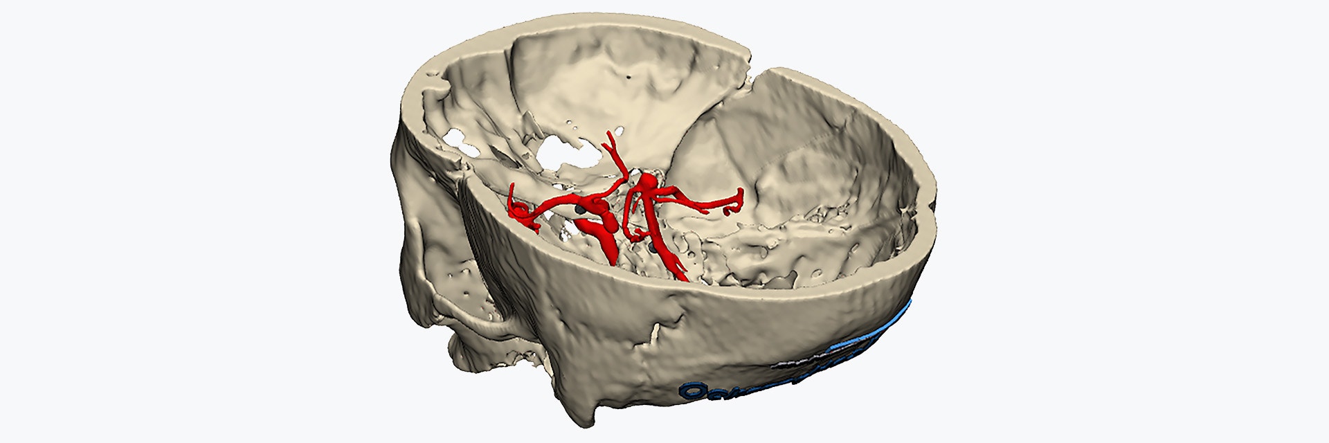 3D-rendered partial skull model with red-highlighted brain blood vessels visible inside.