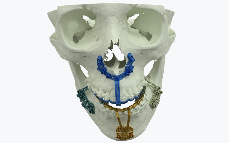 A skull model with personalized, tooth-supported, titanium guides attached