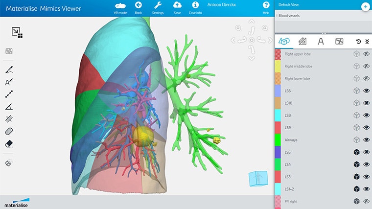 Screenshot of Materialise Mimics Viewer, showing various segments of lung anatomy and their labels
