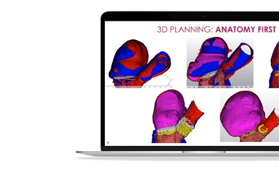 ssm-structural-heart-therapy-3d-planning-anatomy.jpg