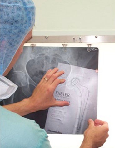 A surgeon using an acetate template to do preoperational planning.