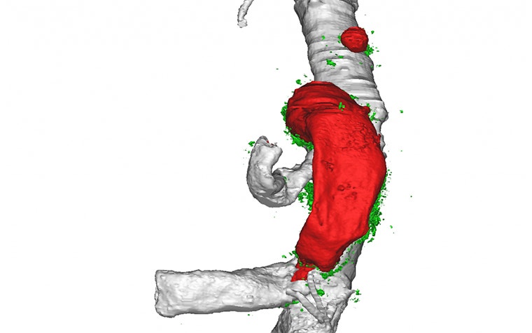 Close-up of the tear of the abdominal aortic aneurysms 