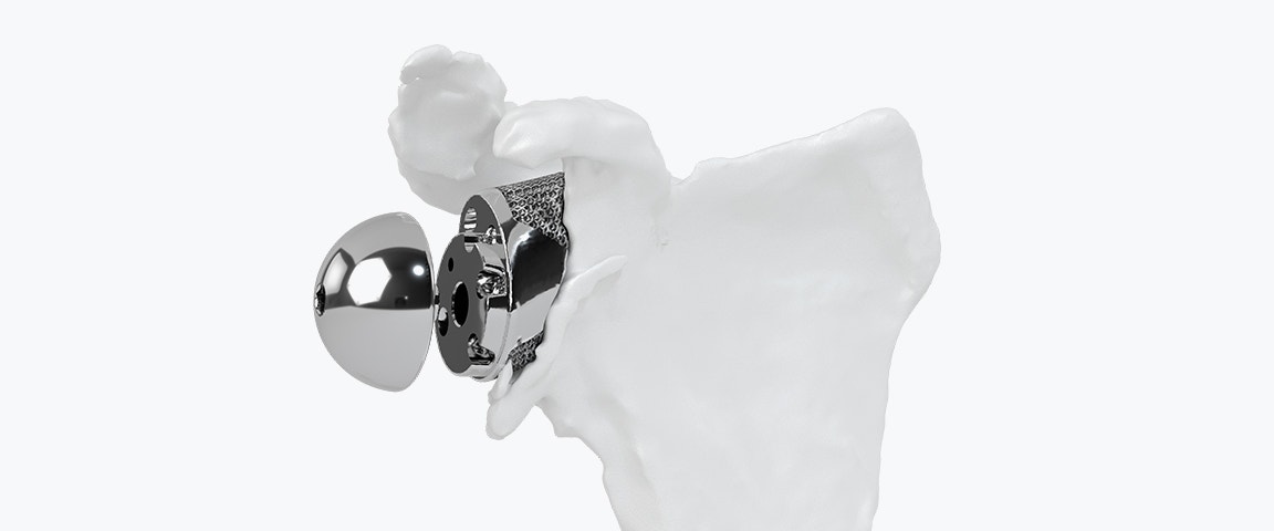 Implante de hombro Glenius impreso en 3D en un modelo de hombro