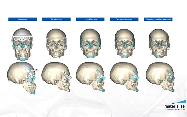 3D scans of a human skull from different perspectives with personalized medical implants. 