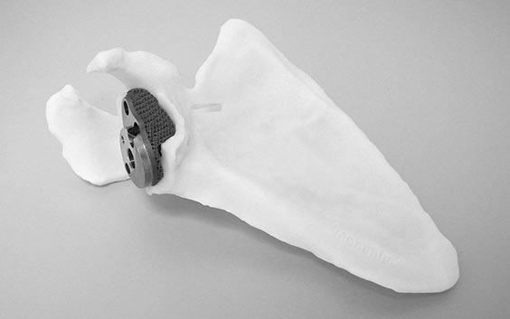 Personalized, 3D-printed implant in a shoulder model