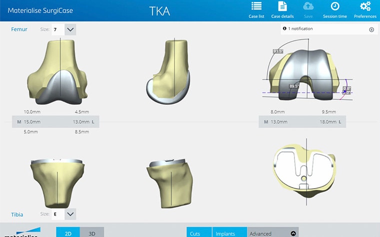 View of a TKA surgery plan on Surgicase 