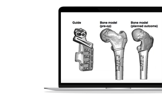 ssm-3d-printed-guide-planning-bone-model-renders.jpg