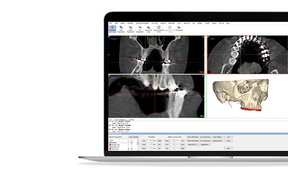 Pantalla que muestra varias imágenes de un cráneo en el módulo de simulación Mimics Innovation Suite.