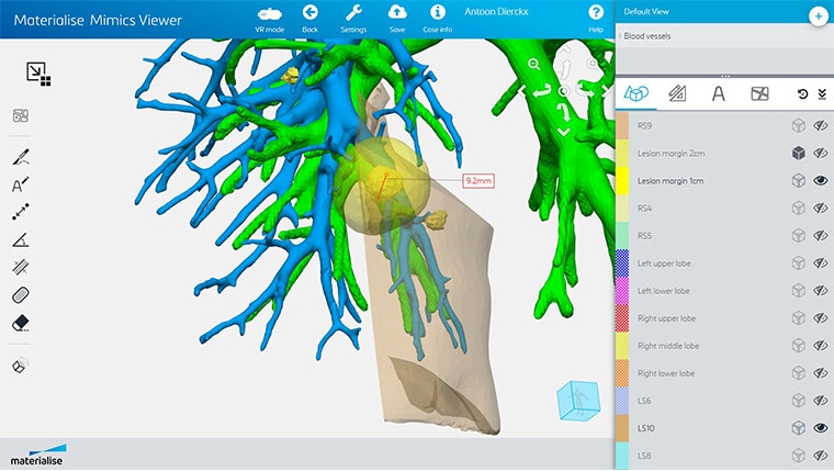 Screenshot of the Mimics Viewer software, showing measurements on a part of lung anatomy