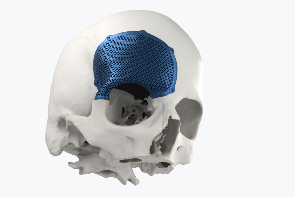 Moitié supérieure d'un modèle de crâne avec un implant CMF imprimé en 3D