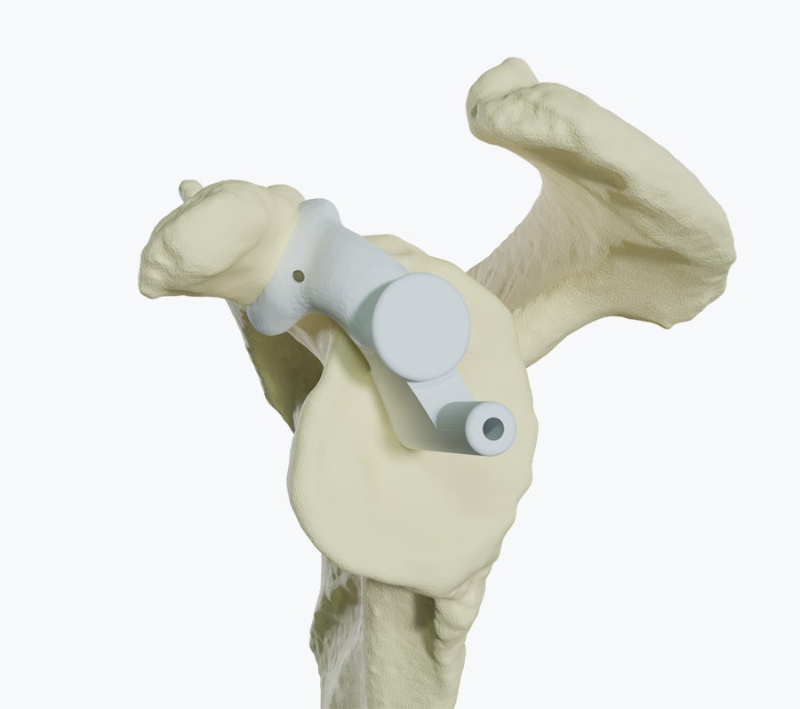 Coracoid fit