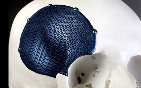 3D-printed titanium implant on a skull
