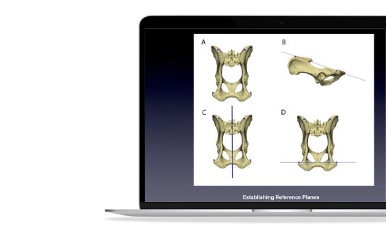 ssm-dog-bone-measurements-estabilishing-reference-planes.jpg