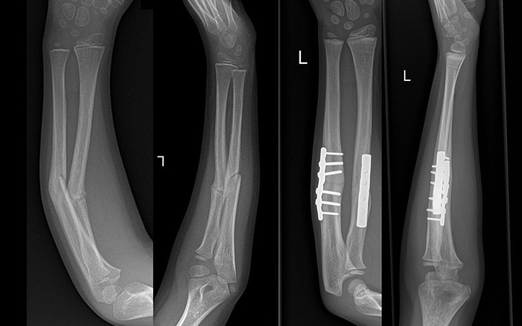 X-ray images of the injured arm before surgery next to X-rays of the arm post-operation with 3D-printed surgical guides 