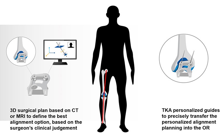 An illustration that shows 3D surgical plan based on CT or MRI to define the best alignment option 