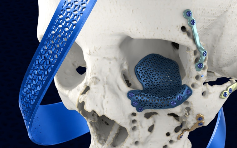 Skull model with various 3D-printed CMF implants in place