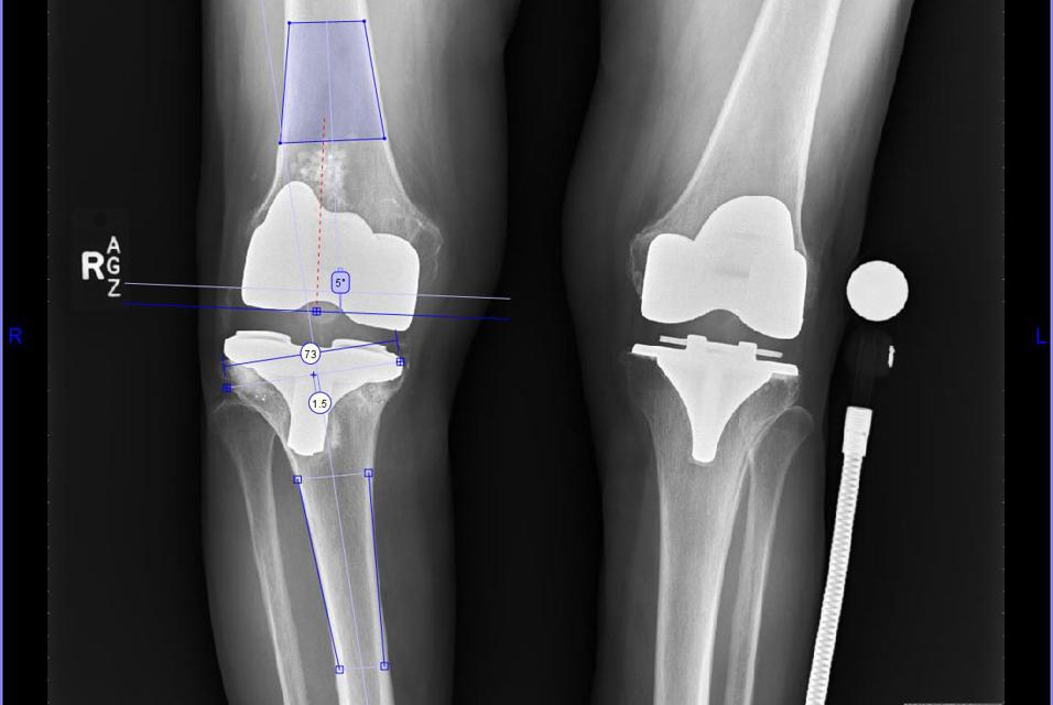 Measurements on an X-ray of a patient's knee