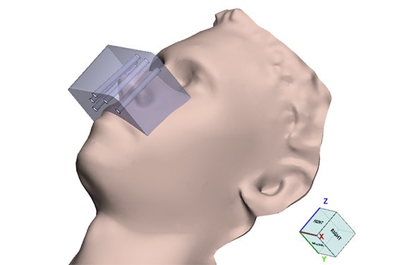 A 3D render of a brachytherapy applicator shown on a model.
