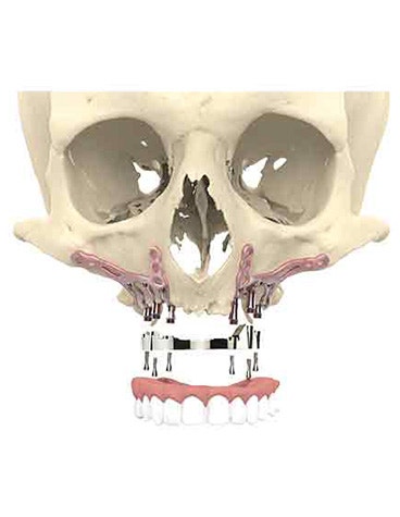 Front view of a skull model with implants that attach teeth to the skull