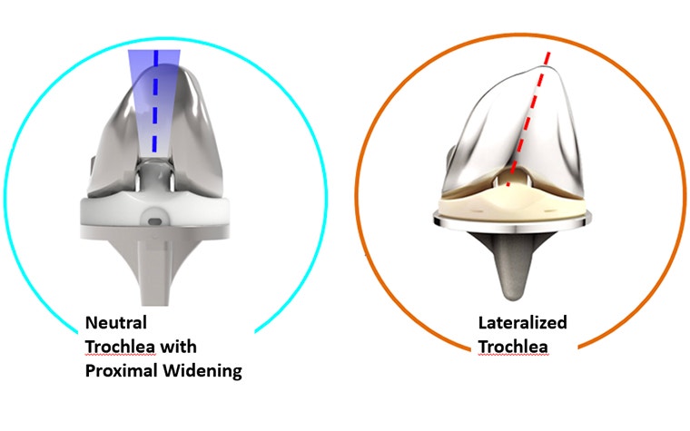 Graphic showing neutral trochlea with proximal widening vs. lateralized trochlea