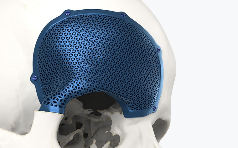Vue rapprochée d'un implant CMF poreux en titane, imprimé en 3D