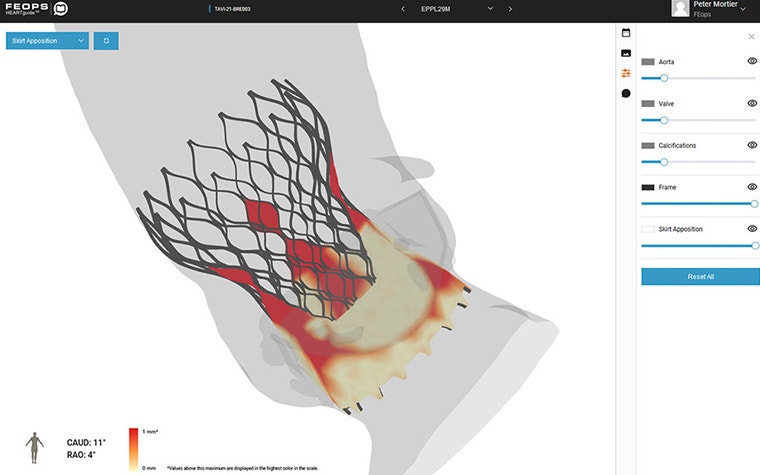 FEops HEARTguideによるTAVI症例のシミュレーション