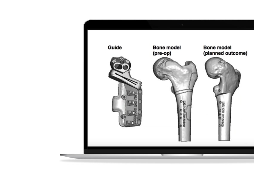 ssd-3d-printed-guide-planning-bone-model-renders.jpg