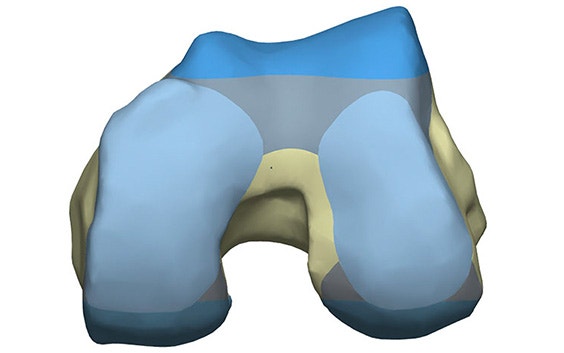Imagen digital de un hueso con la herramienta de resección en color