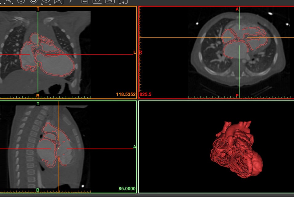 Vue de l'anatomie dans le logiciel Mimics inPrint