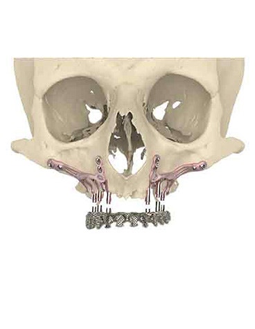 Front view of a skull model with implants to the skull