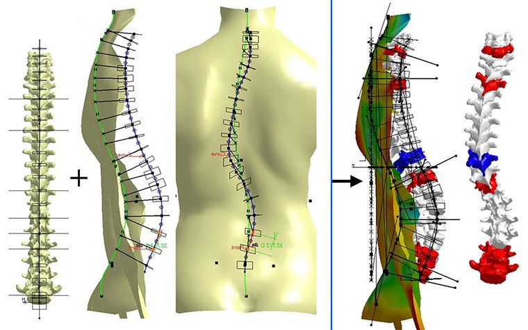 Scoliosis