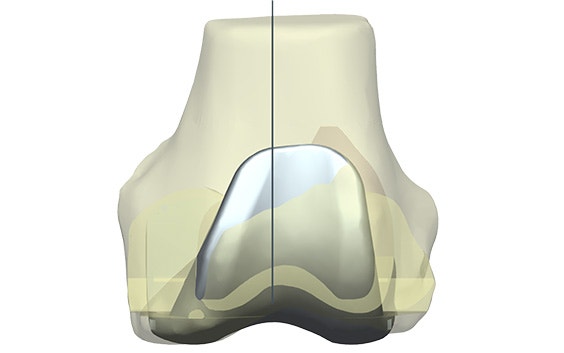 Digital image of a bone implant overlay