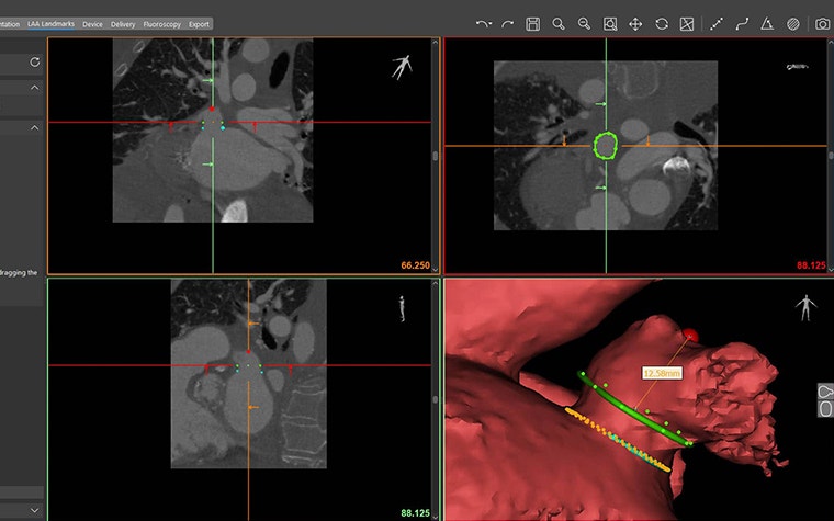 Screenshot of automatic appendage depth measurement in the Mimics Enlight software 