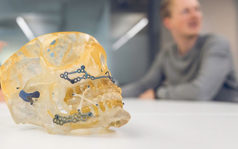 Skull model with 3D-printed titanum implants sitting on a table in front of a person