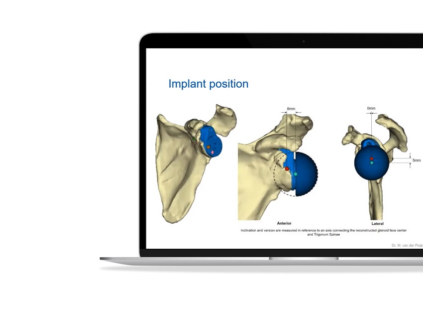 ssd-glenius-shoulder-implant-position-models.jpg