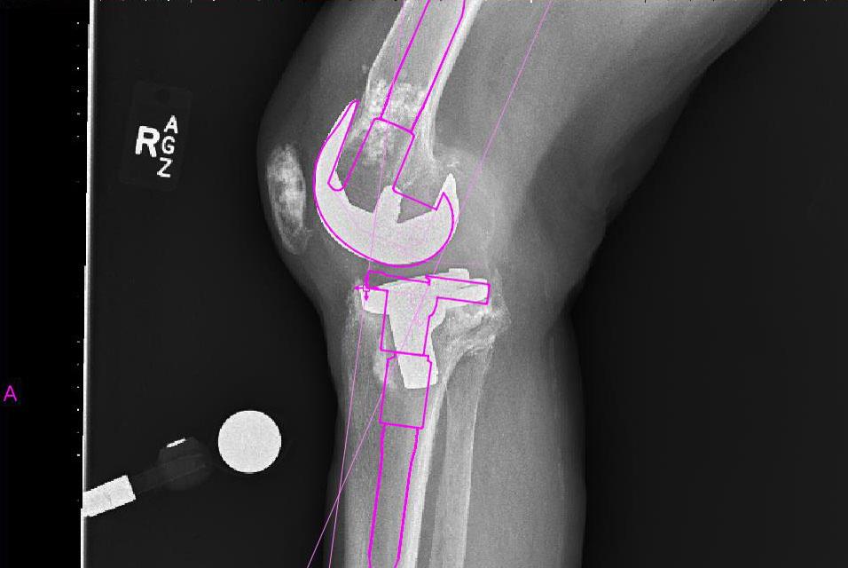 Side X-ray of a patient's knee