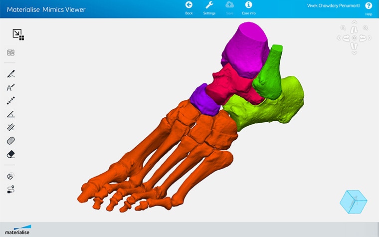 Screenshot of Materialise Mimics Viewer showing segmented foot anatomy