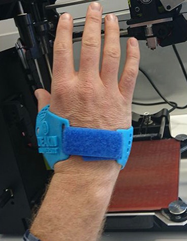 Personalized, 3D-printed thumb splint on an open hand
